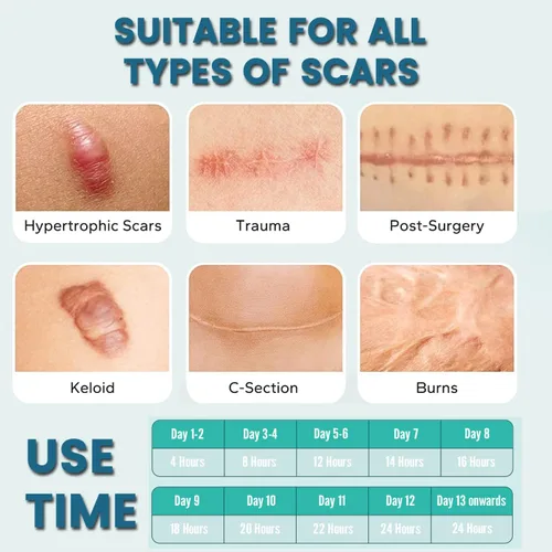 Vista 5 de Hojas de silicona para cicatrices (2 rollos), cinta de silicona para cicatrices de grado médico, tiras de eliminación de cicatrices para acné