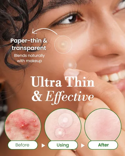 Vista 5 de Parche invisible para espinillas, parches clásicos para el acné hidrocoloide para la cara, parches de acné ultrafinos con mango fácil de despegar