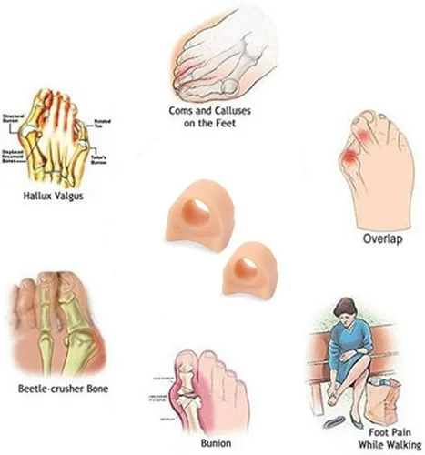 Vista 2 de Paquete de 4 separadores de dedos de gel para corrector de juanetes y alivio, Hallux Valgus, beige